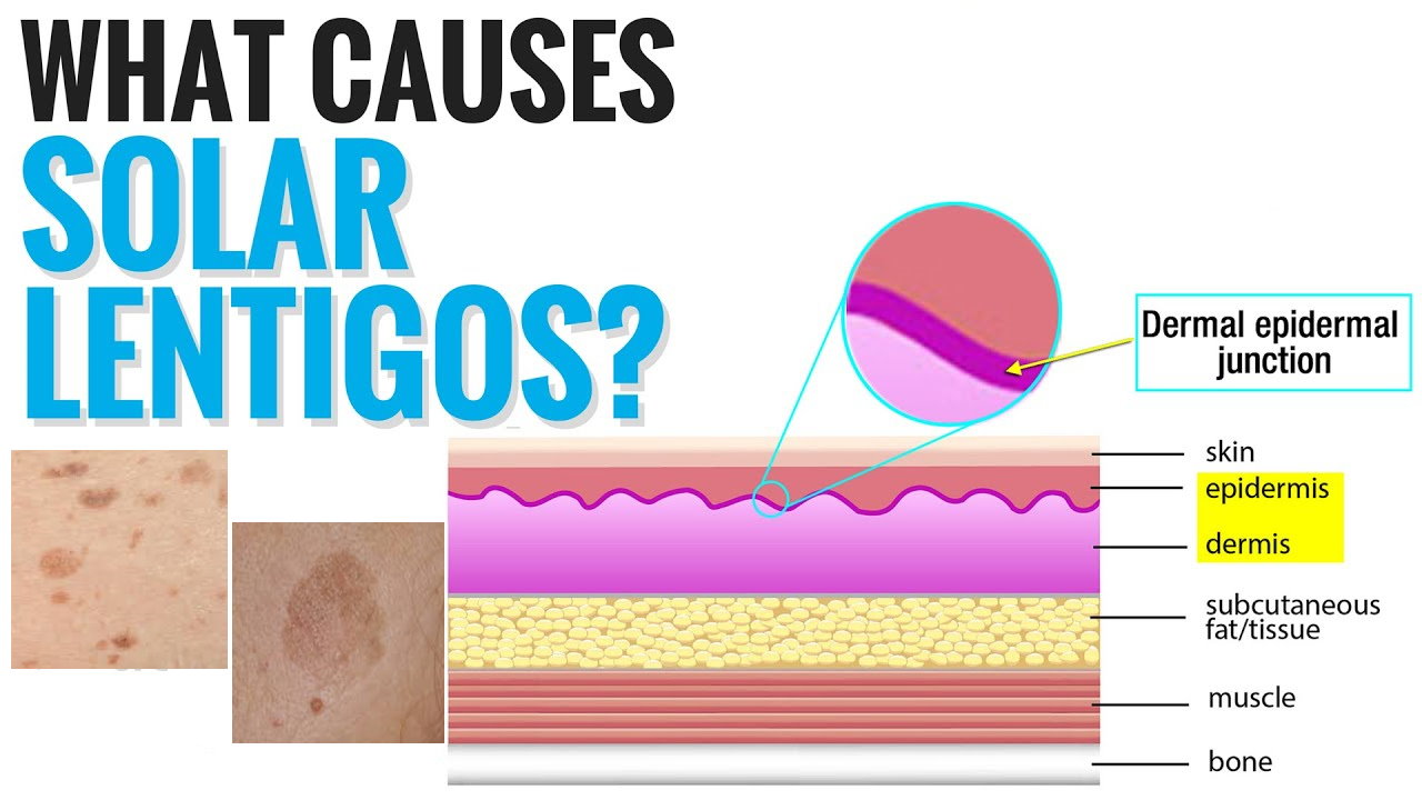 孚立美“氟轻松氢醌维A酸乳膏”能用于老年斑治疗吗？