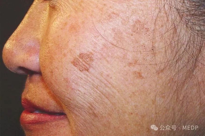 老年斑、晒斑、日光性雀斑是一回事吗？